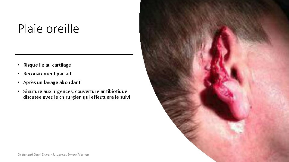 Plaie oreille • Risque lié au cartilage • Recouvrement parfait • Après un lavage