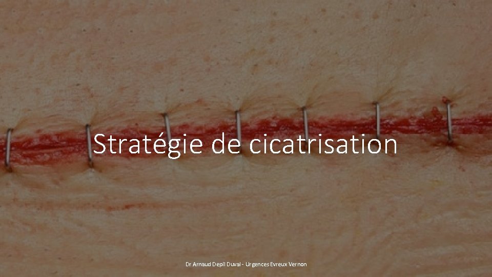 Stratégie de cicatrisation Dr Arnaud Depil Duval - Urgences Evreux Vernon 