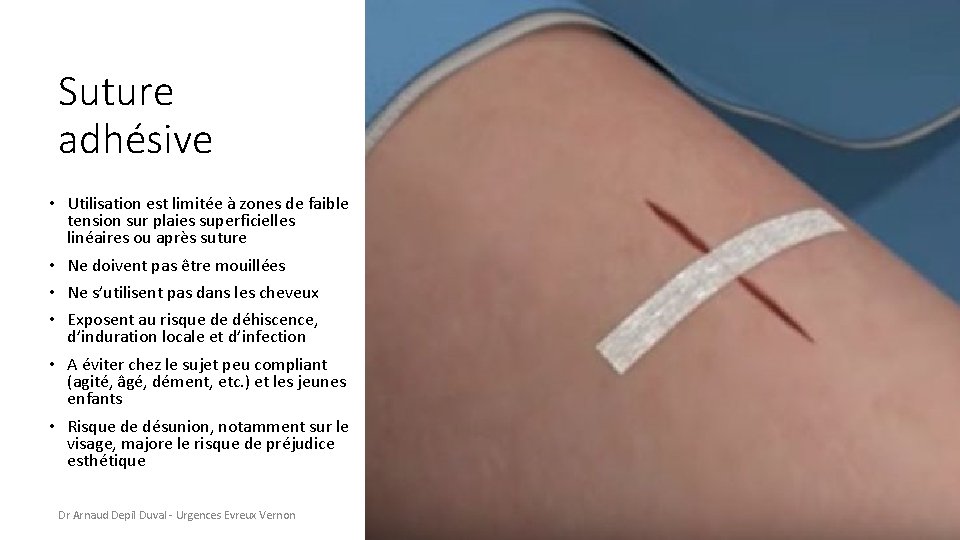 Suture adhésive • Utilisation est limitée à zones de faible tension sur plaies superficielles