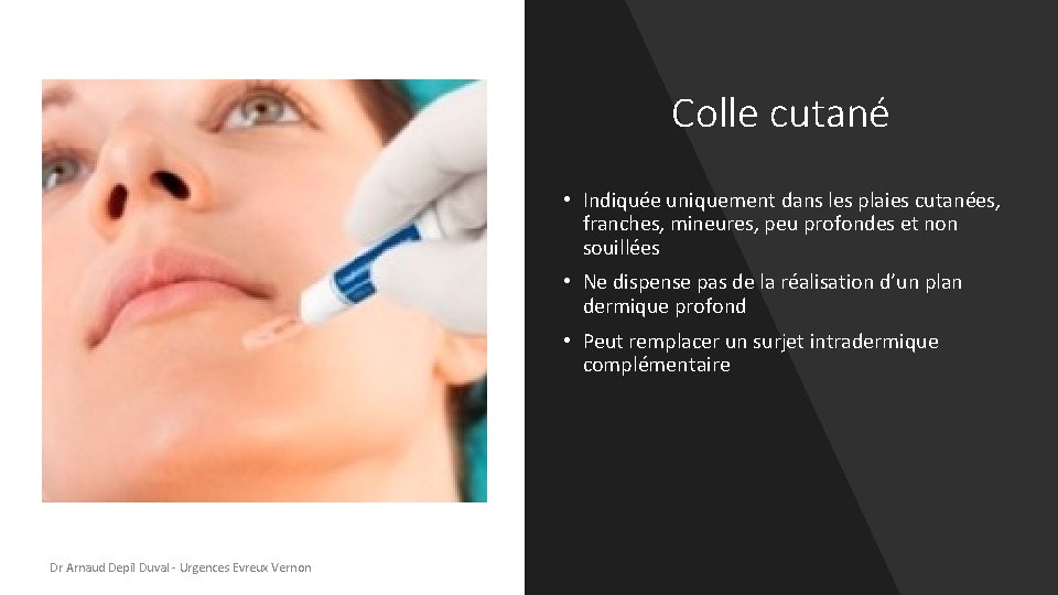 Colle cutané • Indiquée uniquement dans les plaies cutanées, franches, mineures, peu profondes et