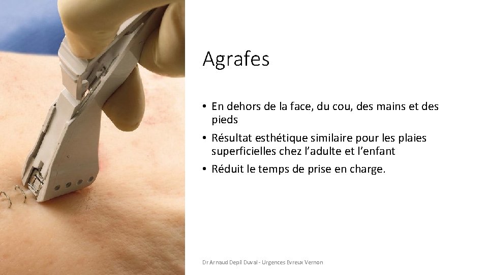 Agrafes • En dehors de la face, du cou, des mains et des pieds