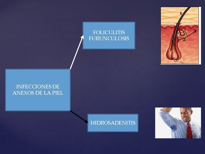 FOLICULITIS FURUNCULOSIS INFECCIONES DE ANEXOS DE LA PIEL HIDROSADENITIS 