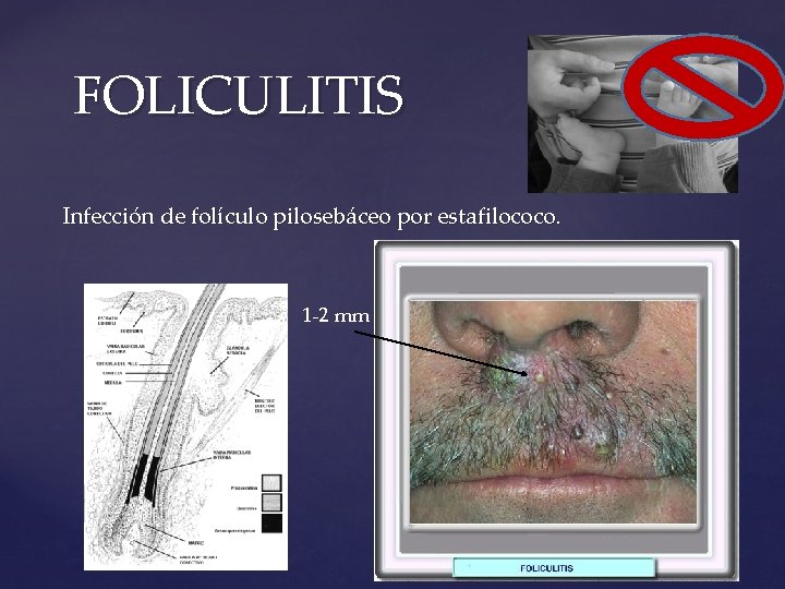 FOLICULITIS Infección de folículo pilosebáceo por estafilococo. 1 -2 mm 