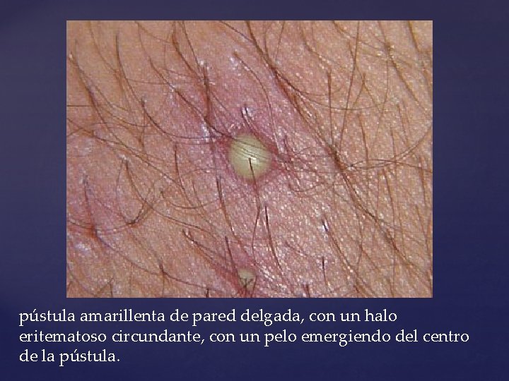 pústula amarillenta de pared delgada, con un halo eritematoso circundante, con un pelo emergiendo