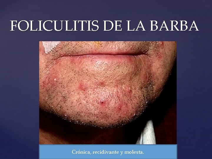 FOLICULITIS DE LA BARBA Crónica, recidivante y molesta. 