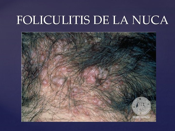 FOLICULITIS DE LA NUCA 