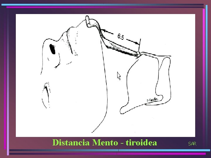 Distancia Mento - tiroidea SAR 