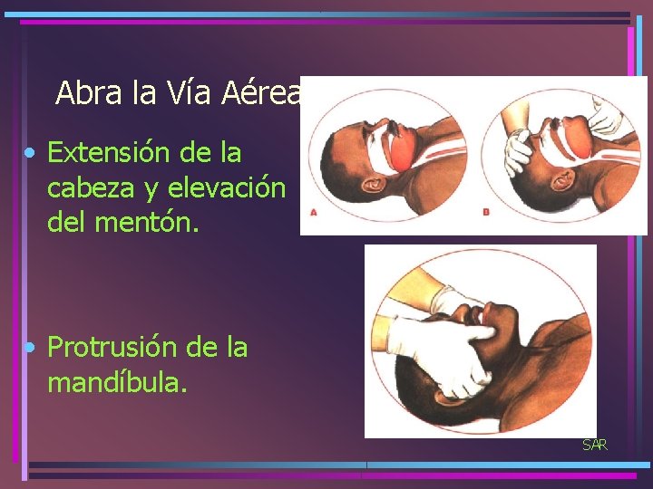 Abra la Vía Aérea • Extensión de la cabeza y elevación del mentón. •