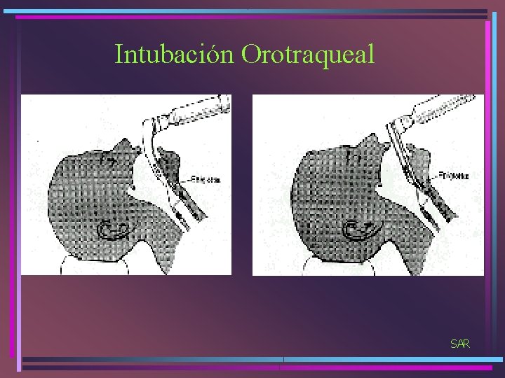 Intubación Orotraqueal SAR 
