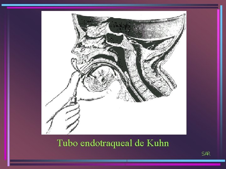 Tubo endotraqueal de Kuhn SAR 