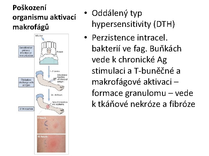 Poškození • Oddálený typ organismu aktivací hypersensitivity (DTH) makrofágů • Perzistence intracel. bakterií ve