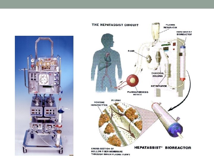 History of Bioartificial liver devices