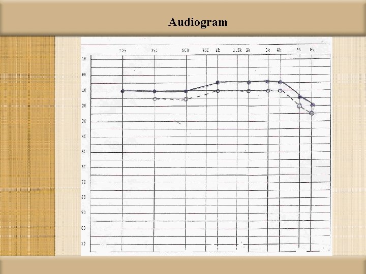 Audiogram 