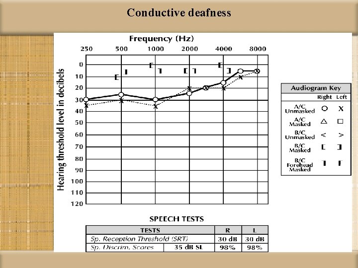 Conductive deafness 