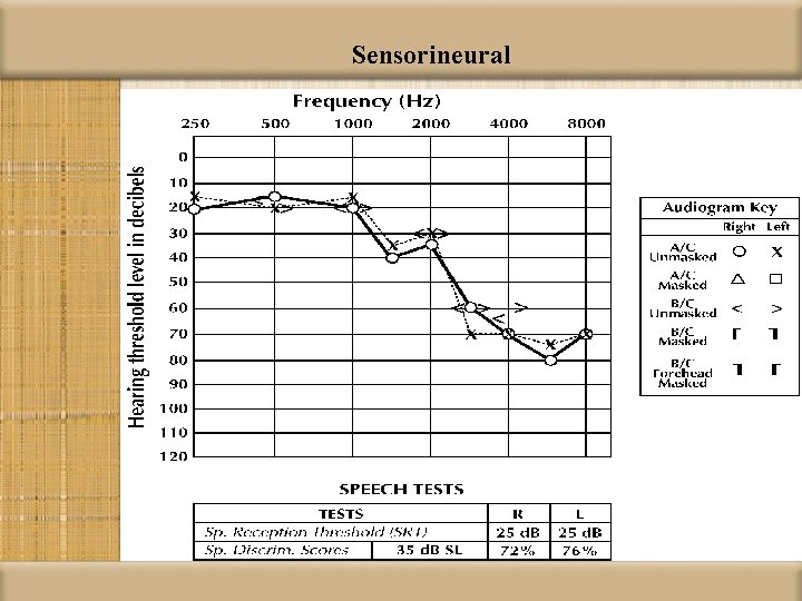 Sensorineural 