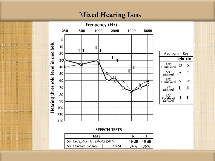 Mixed Hearing Loss 