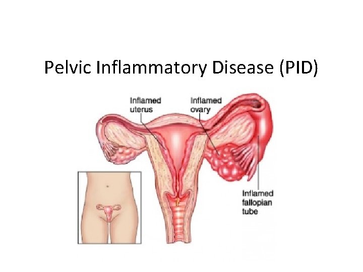 Pelvic Inflammatory Disease (PID) 