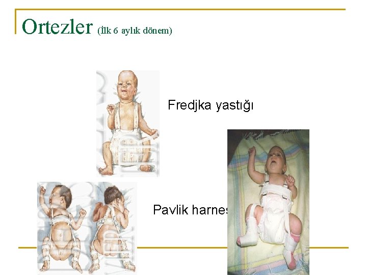 Ortezler (İlk 6 aylık dönem) Fredjka yastığı Pavlik harnes 