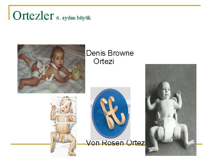 Ortezler 6. aydan büyük Denis Browne Ortezi Von Rosen Ortezi 