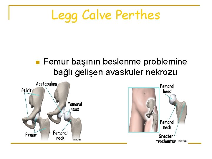 Legg Calve Perthes n Femur başının beslenme problemine bağlı gelişen avaskuler nekrozu 