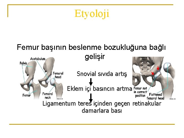 Etyoloji Femur başının beslenme bozukluğuna bağlı gelişir Snovial sıvıda artış Eklem içi basıncın artması