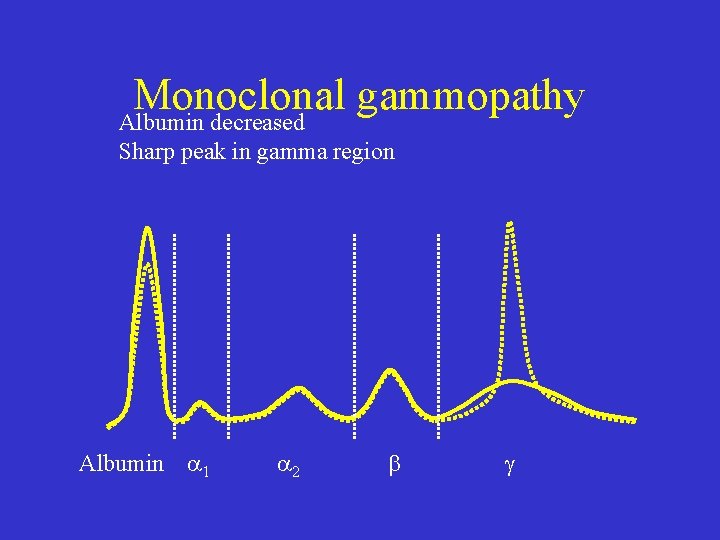 Monoclonal gammopathy Albumin decreased Sharp peak in gamma region Albumin 1 2 