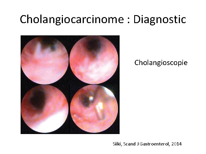 Cholangiocarcinome : Diagnostic Cholangioscopie Siiki, Scand J Gastroenterol, 2014 