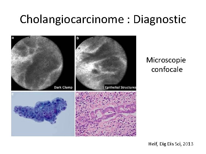 Cholangiocarcinome : Diagnostic Microscopie confocale Heif, Dig Dis Sci, 2013 