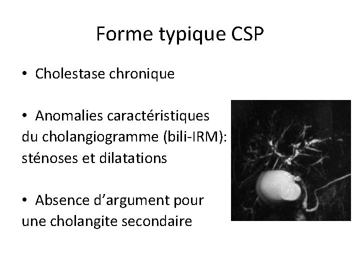 Forme typique CSP • Cholestase chronique • Anomalies caractéristiques du cholangiogramme (bili-IRM): sténoses et
