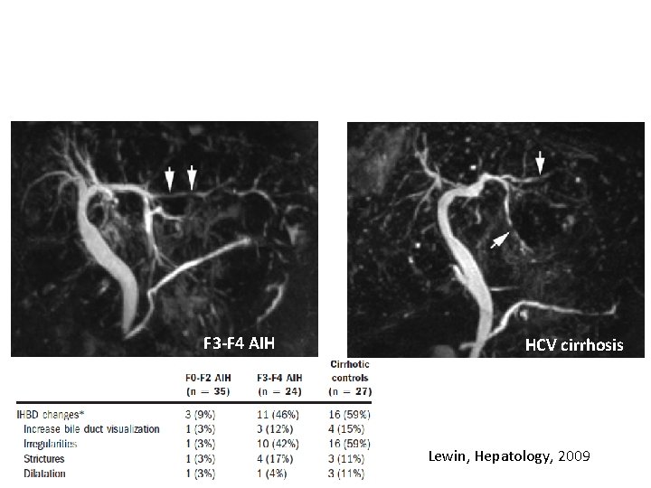 F 3 -F 4 AIH HCV cirrhosis Lewin, Hepatology, 2009 