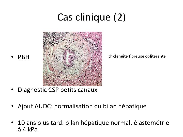 Cas clinique (2) • PBH cholangite fibreuse oblitérante • Diagnostic CSP petits canaux •