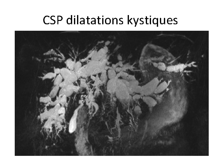 CSP dilatations kystiques 
