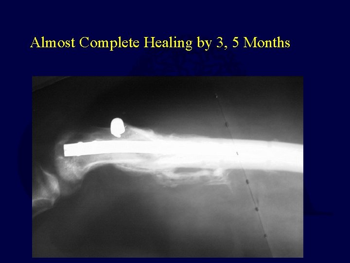 Almost Complete Healing by 3, 5 Months Almost Complete Healing by 3, 5 Months