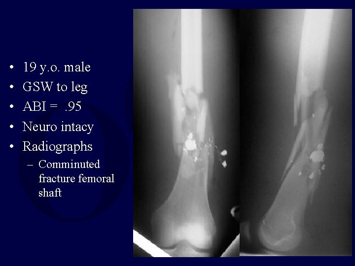 • • • 19 y. o. male GSW to leg ABI =. 95 • • • 19 y. o. male GSW to leg ABI =. 95