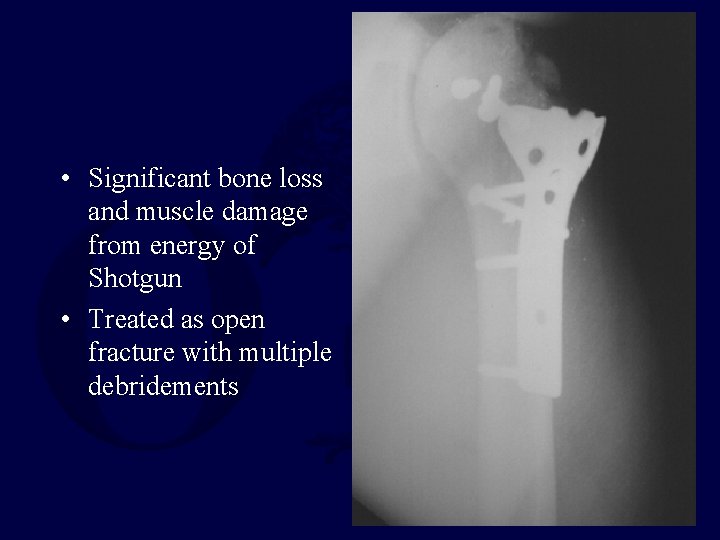 • Significant bone loss and muscle damage from energy of Shotgun • Treated • Significant bone loss and muscle damage from energy of Shotgun • Treated