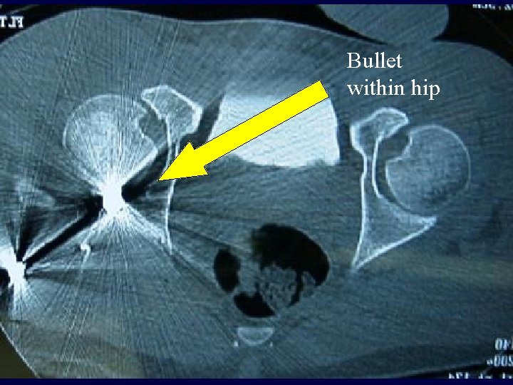 Bullet within hip Bullet within hip