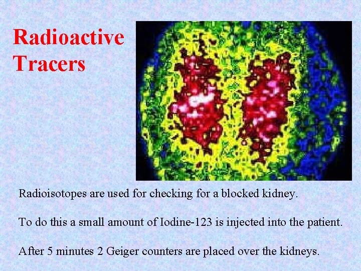 Radioactive Tracers Radioisotopes are used for checking for a blocked kidney. To do this Radioactive Tracers Radioisotopes are used for checking for a blocked kidney. To do this