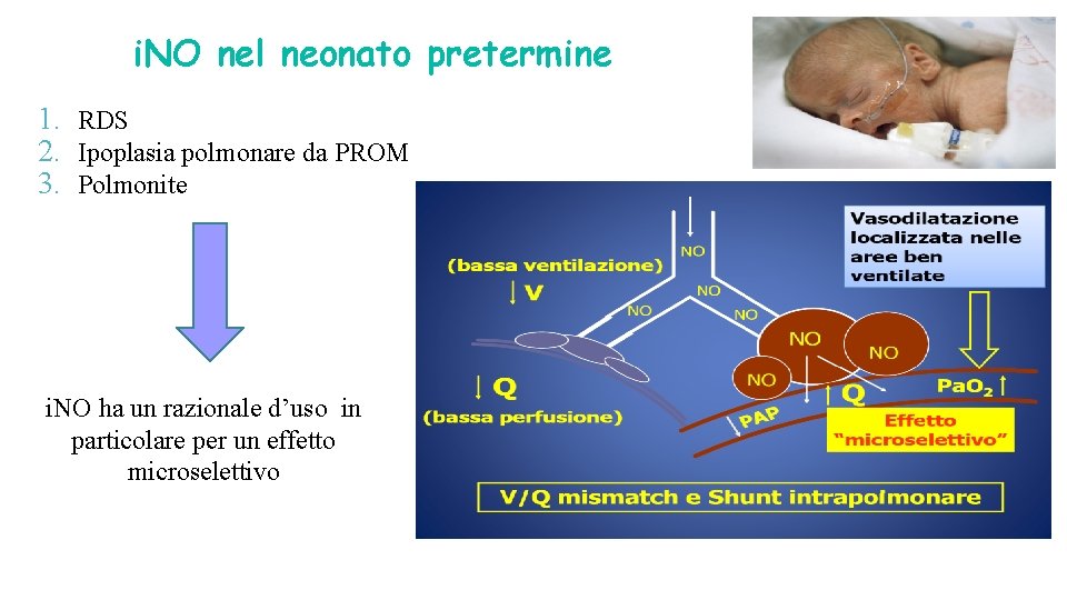 i. NO nel neonato pretermine 1. RDS 2. Ipoplasia polmonare da PROM 3. Polmonite