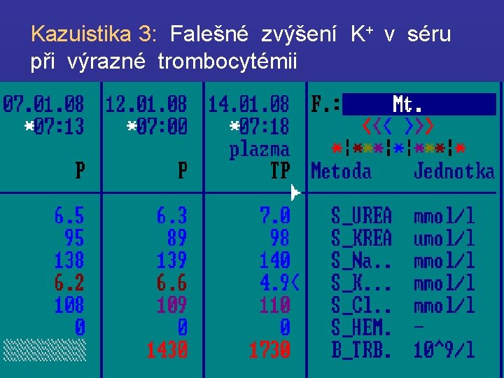 Kazuistika 3: Falešné zvýšení K+ v séru při výrazné trombocytémii 