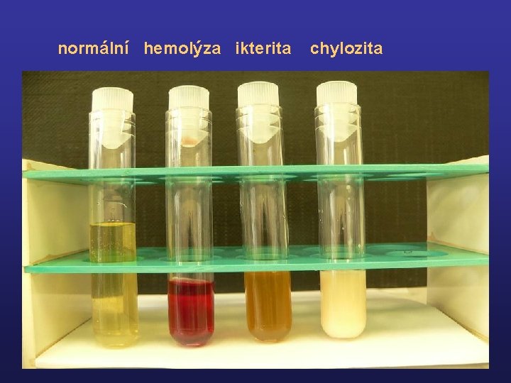 normální hemolýza ikterita chylozita 