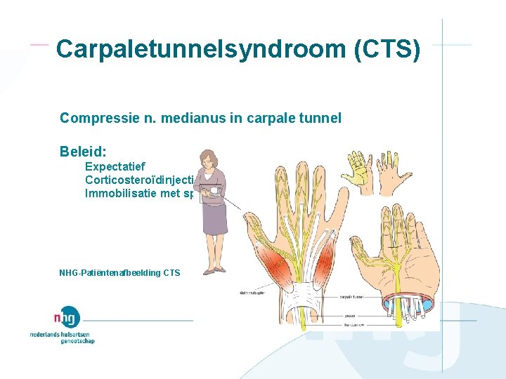 Carpaletunnelsyndroom (CTS) Compressie n. medianus in carpale tunnel Beleid: Expectatief Corticosteroïdinjectie Immobilisatie met spalk