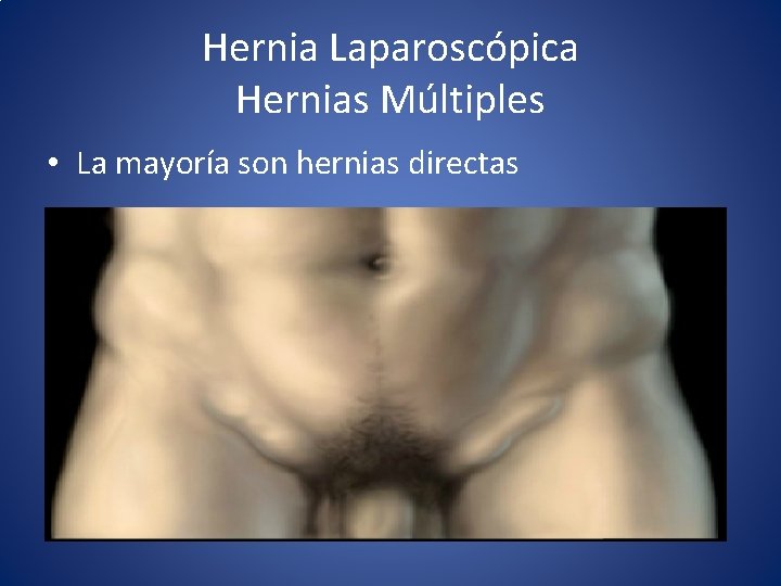 Hernia Laparoscópica Hernias Múltiples • La mayoría son hernias directas 