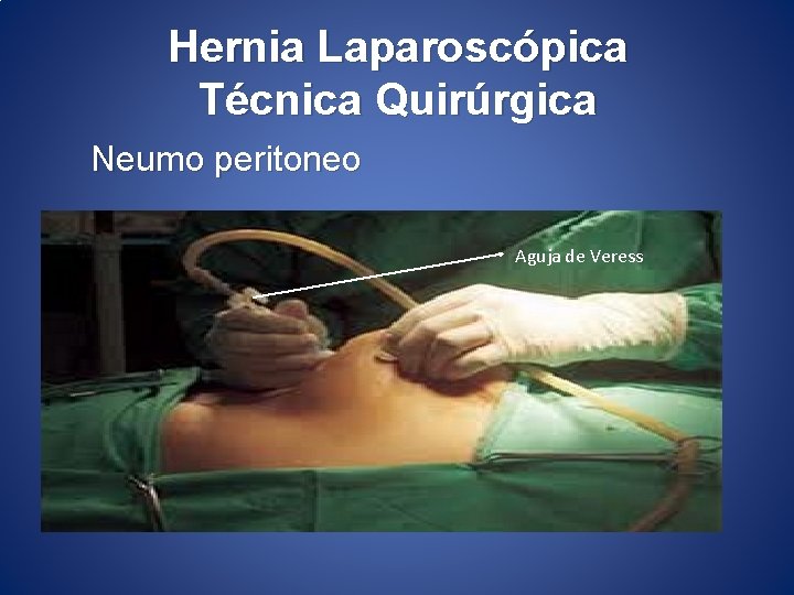 Hernia Laparoscópica Técnica Quirúrgica Neumo peritoneo Aguja de Veress 