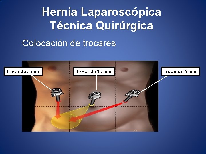 Hernia Laparoscópica Técnica Quirúrgica Colocación de trocares Trocar de 5 mm Trocar de 10