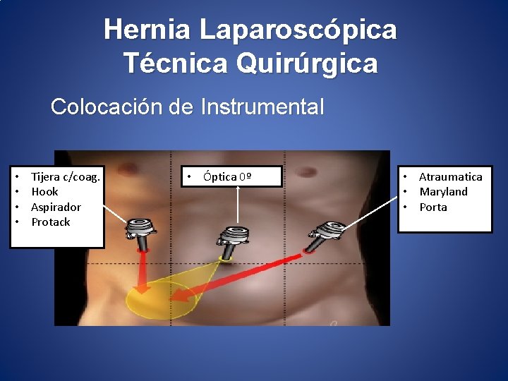 Hernia Laparoscópica Técnica Quirúrgica Colocación de Instrumental • • Tijera c/coag. Hook Aspirador Protack