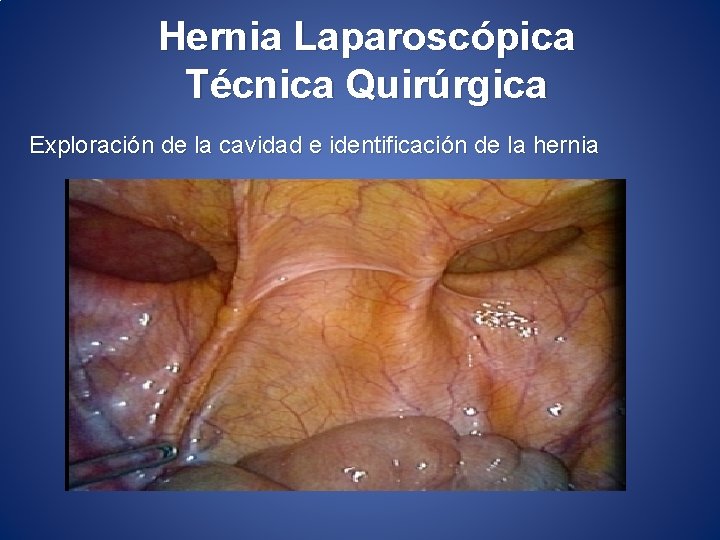 Hernia Laparoscópica Técnica Quirúrgica Exploración de la cavidad e identificación de la hernia 