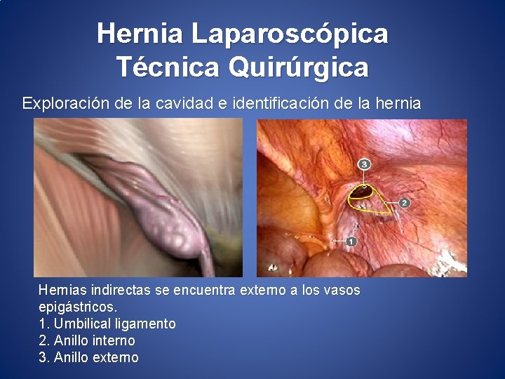Hernia Laparoscópica Técnica Quirúrgica Exploración de la cavidad e identificación de la hernia Hernias