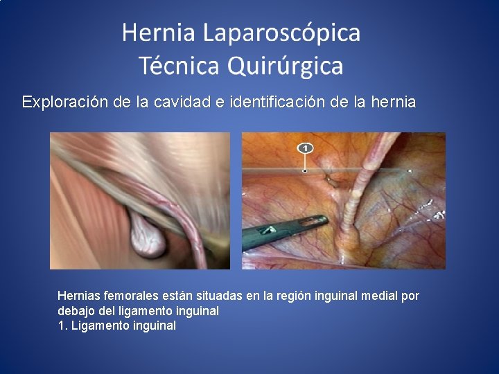  Exploración de la cavidad e identificación de la hernia Hernias femorales están situadas