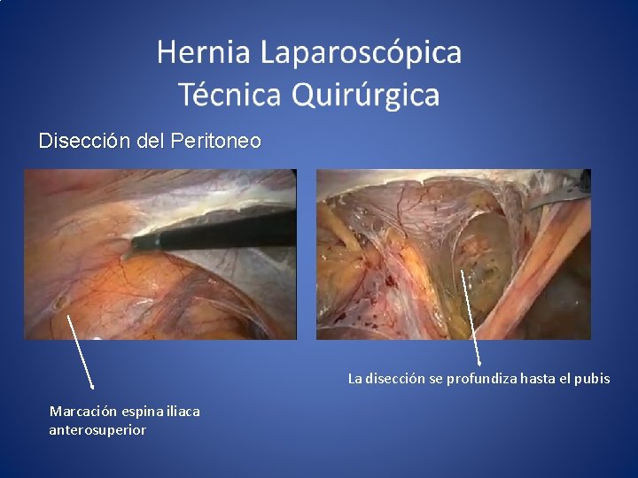  Disección del Peritoneo La disección se profundiza hasta el pubis Marcación espina iliaca