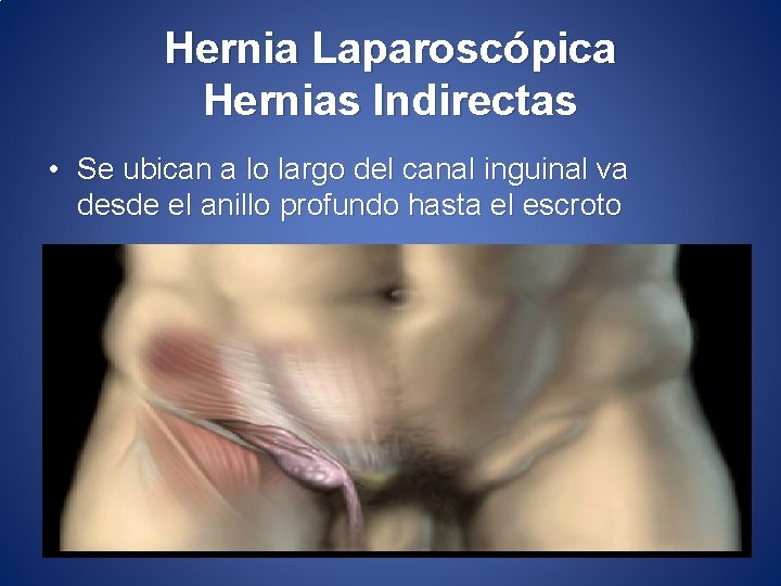 Hernia Laparoscópica Hernias Indirectas • Se ubican a lo largo del canal inguinal va
